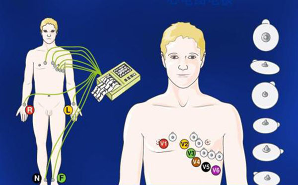 動態(tài)心電佩戴者應(yīng)注意哪些事項